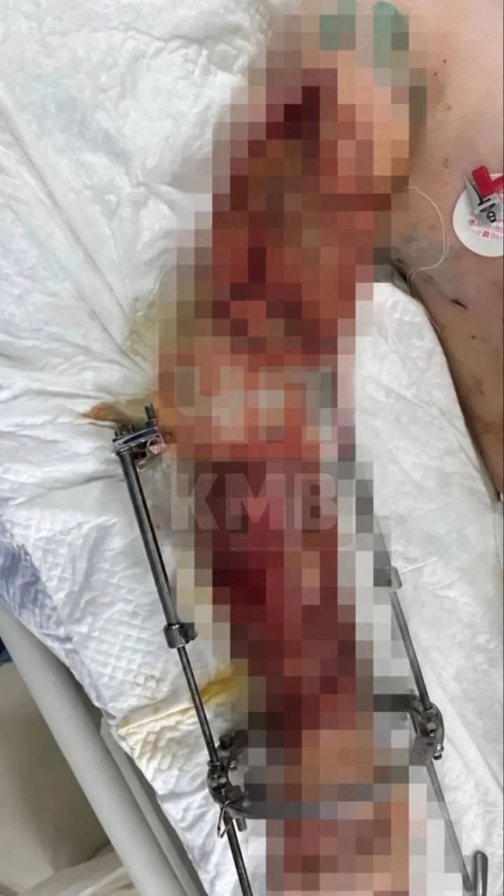 Школьник из Ставрополья спас котёнка и получил 19 переломов